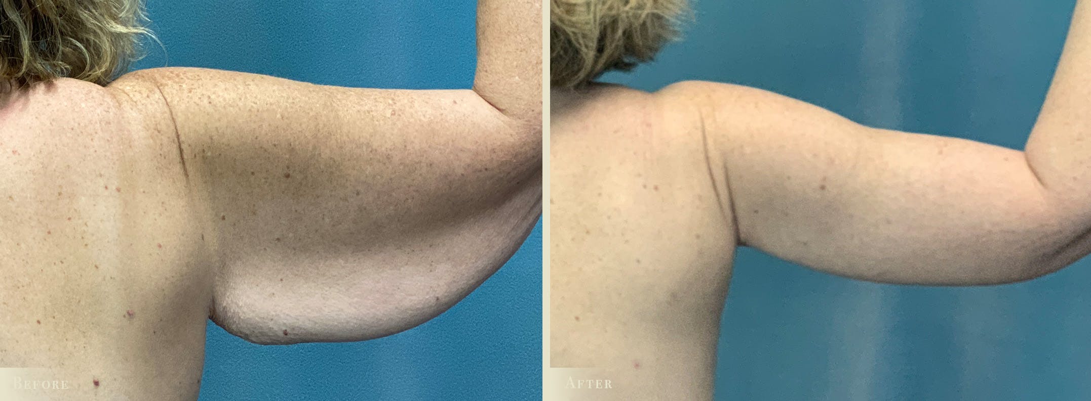 Arm Lift Before & After Gallery - Patient 428730 - Image 2