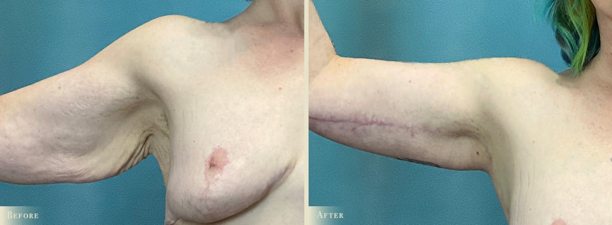 Tummy Tuck Before & After Gallery - Patient 197686 - Image 4