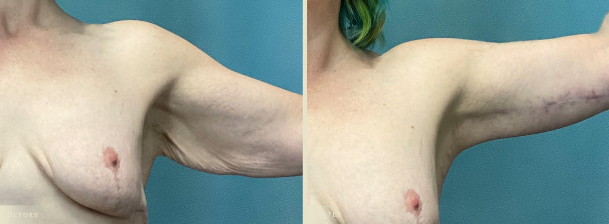 Tummy Tuck Before & After Gallery - Patient 197686 - Image 2