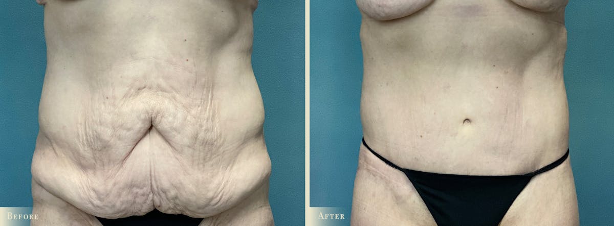 Tummy Tuck Before & After Gallery - Patient 197686 - Image 1