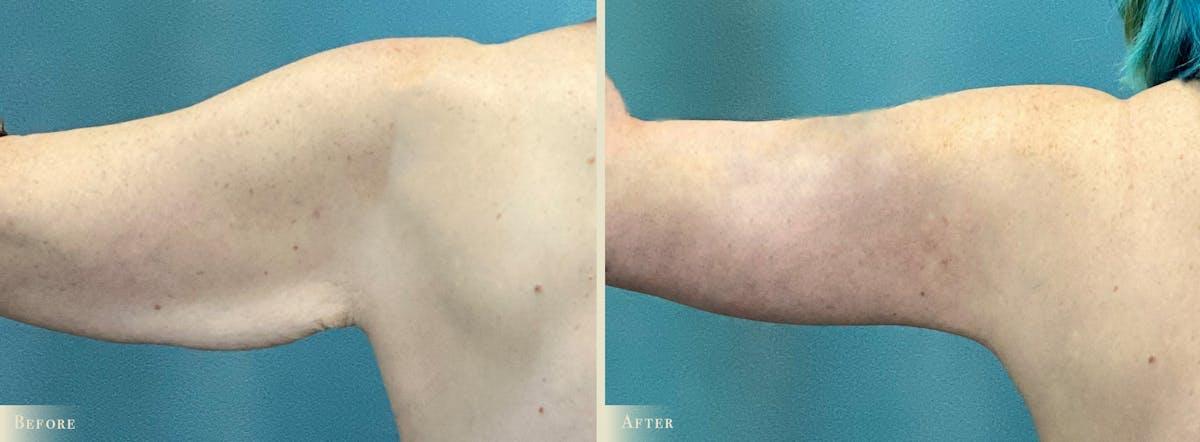 Tummy Tuck Before & After Gallery - Patient 197686 - Image 5