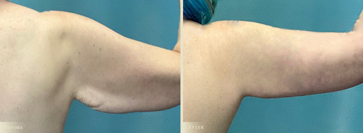 Tummy Tuck Before & After Gallery - Patient 197686 - Image 3