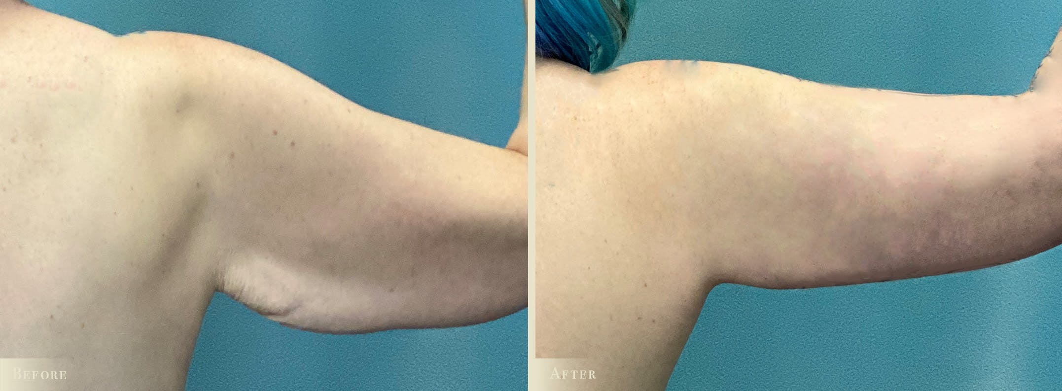 Arm Lift Before & After Gallery - Patient 965038 - Image 2