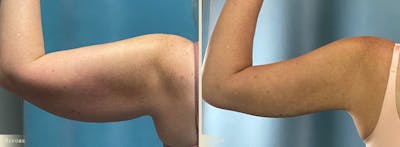 Arm Lift Before & After Gallery - Patient 990839 - Image 4