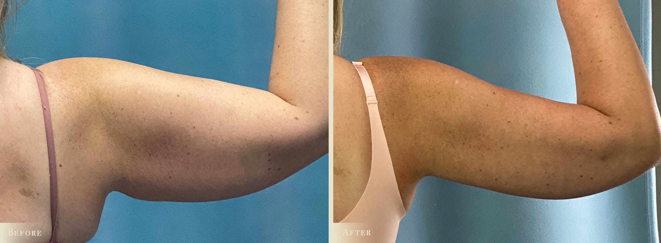 Arm Lift Before & After Gallery - Patient 990839 - Image 2