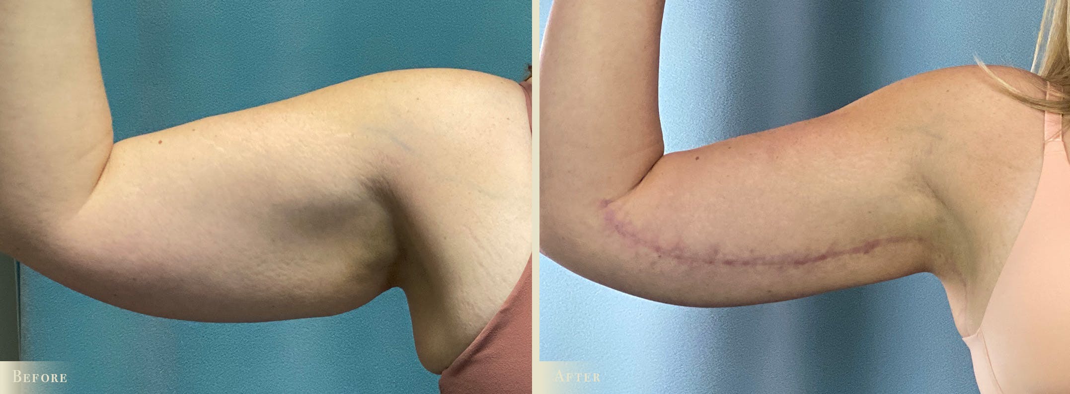 Arm Lift Before & After Gallery - Patient 990839 - Image 3