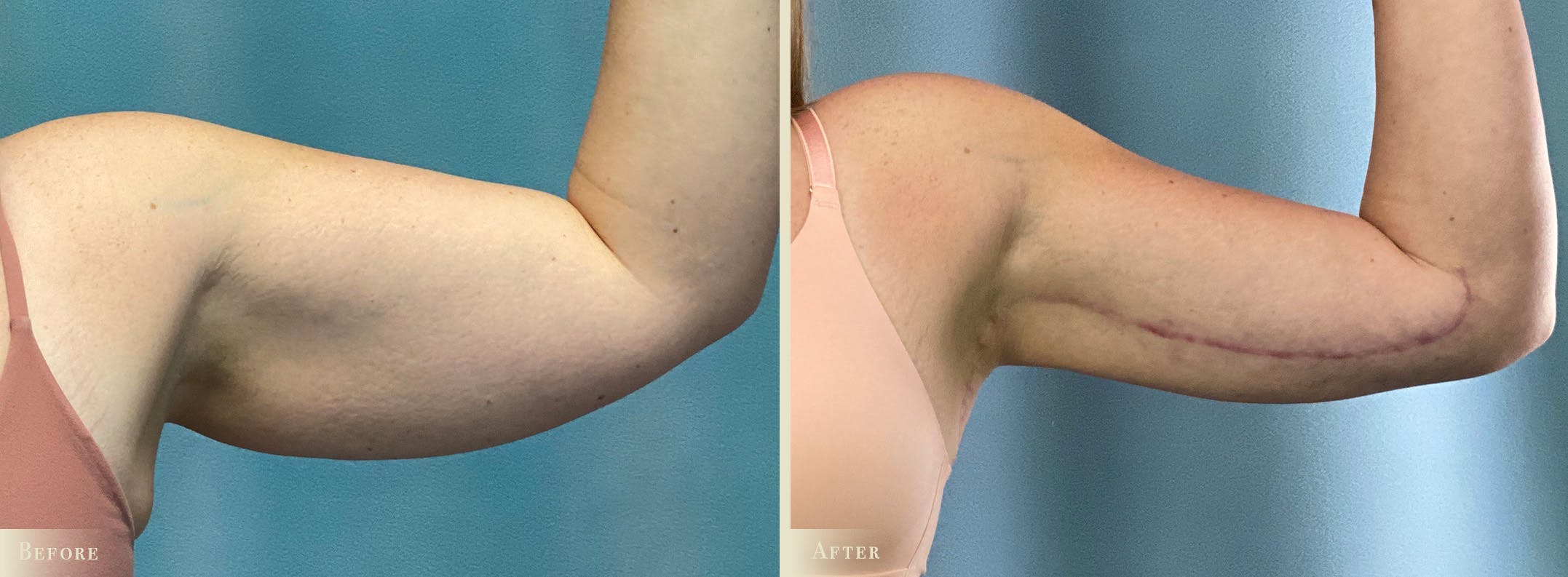 Arm Lift Before & After Gallery - Patient 990839 - Image 1