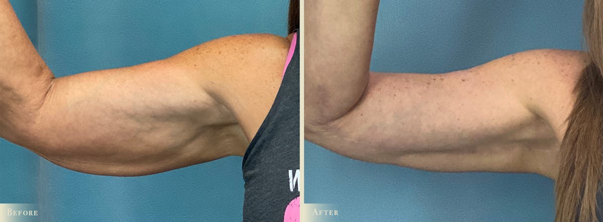 Arm Lift Before & After Gallery - Patient 317181 - Image 3