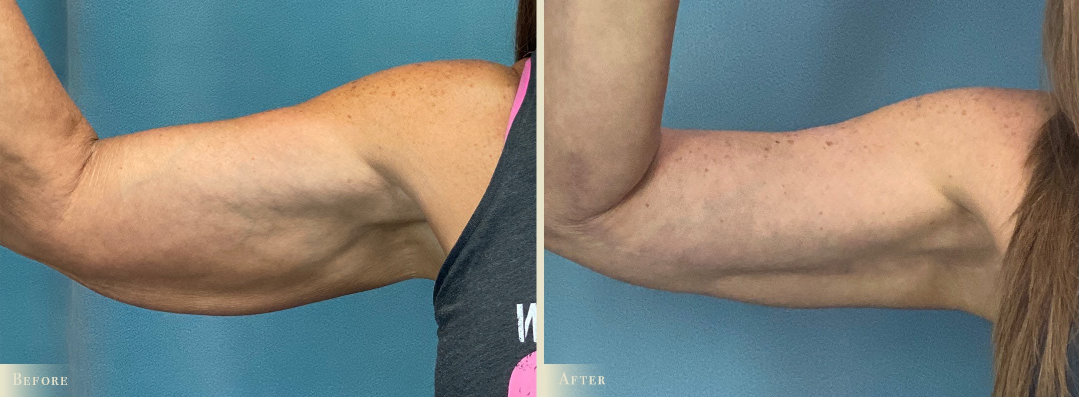 Arm Lift Before & After Gallery - Patient 317181 - Image 3