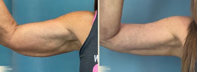 Arm Lift Before & After Gallery - Patient 317181 - Image 3