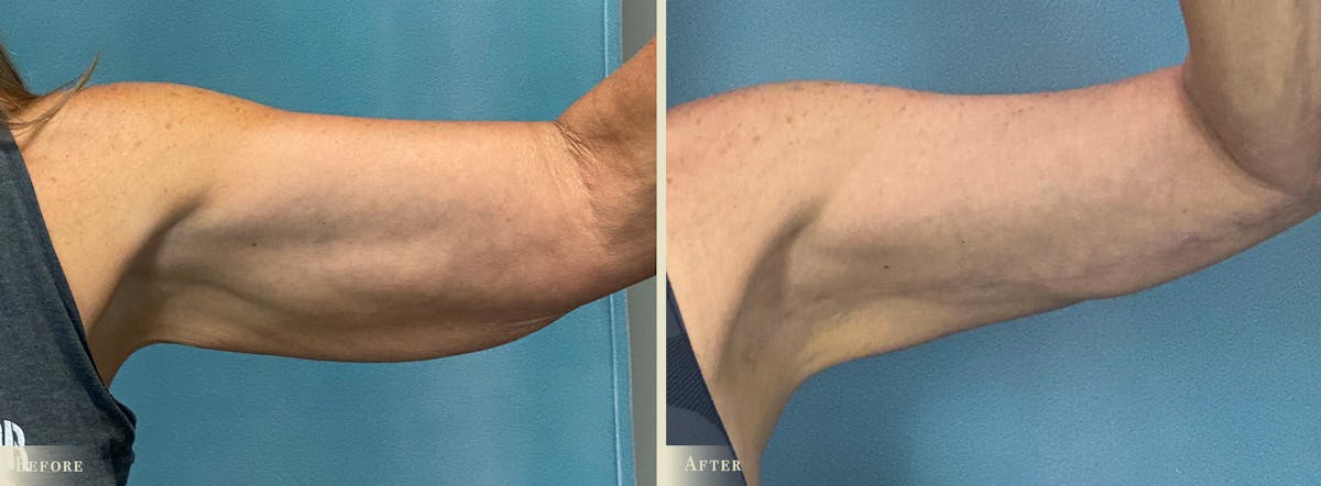 Arm Lift Before & After Gallery - Patient 317181 - Image 1