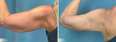 Arm Lift Before & After Gallery - Patient 317181 - Image 4