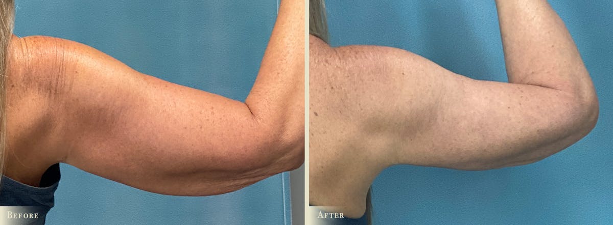 Arm Lift Before & After Gallery - Patient 317181 - Image 2