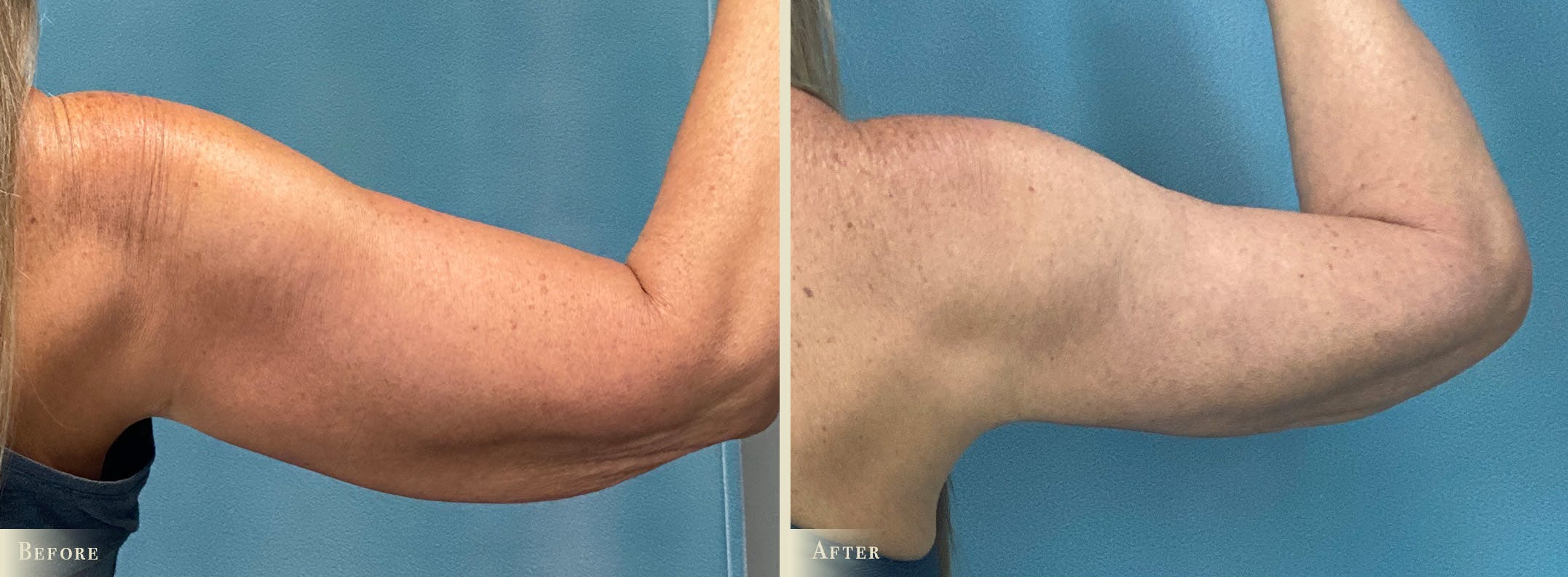 Arm Lift Before & After Gallery - Patient 317181 - Image 2
