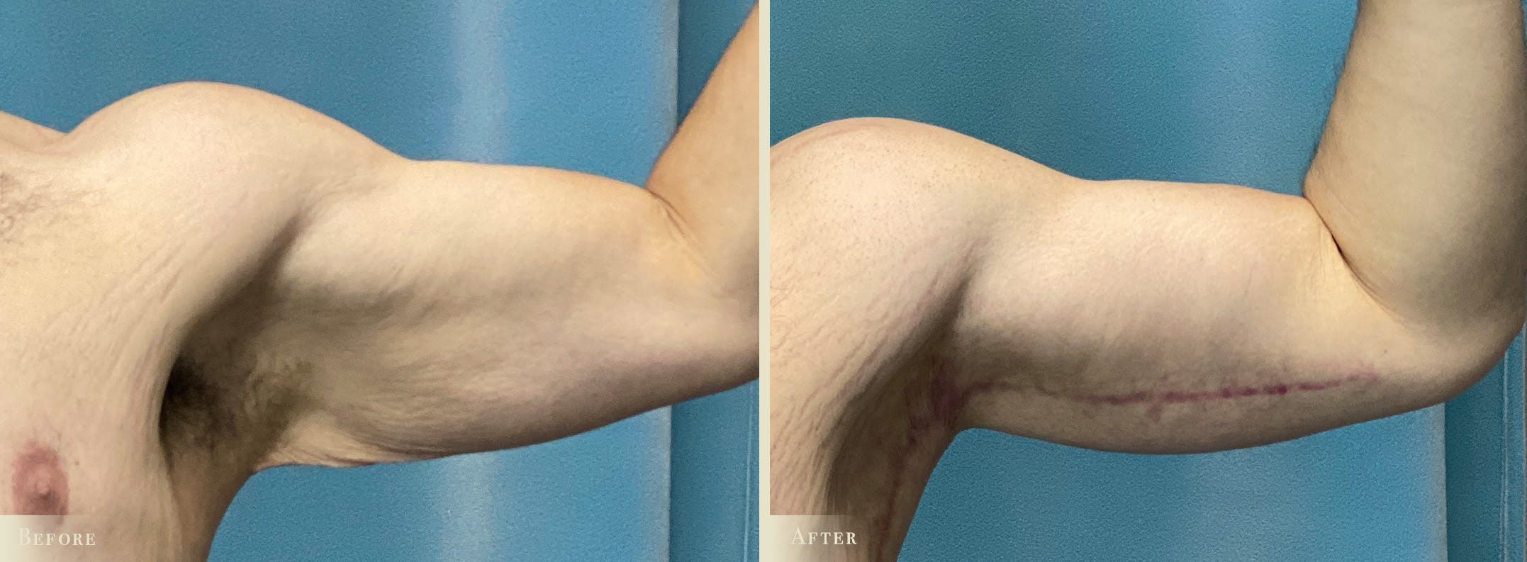 Arm Lift Before & After Gallery - Patient 300817 - Image 1