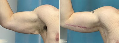 Arm Lift Before & After Gallery - Patient 300817 - Image 3