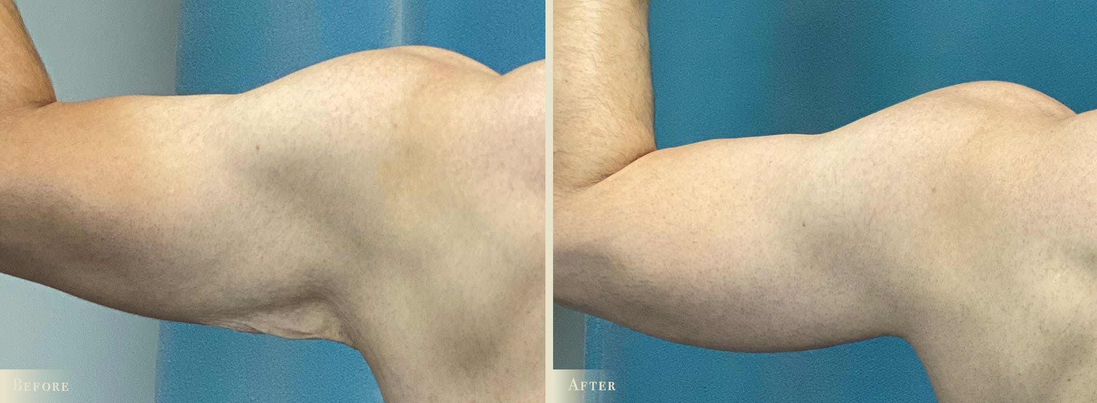 Arm Lift Before & After Gallery - Patient 300817 - Image 4