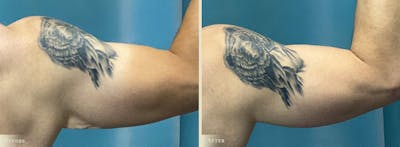 Arm Lift Before & After Gallery - Patient 300817 - Image 2