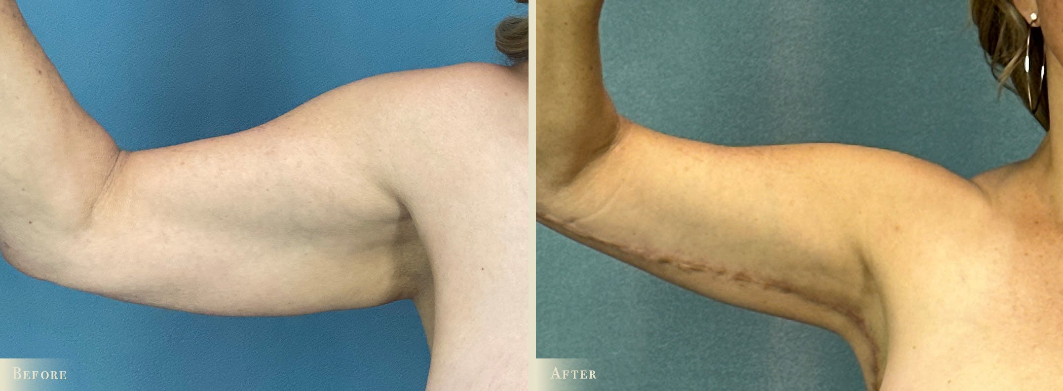 Explant with Lift Before & After Gallery - Patient 293873 - Image 4
