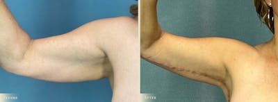 Explant with Lift Before & After Gallery - Patient 293873 - Image 4