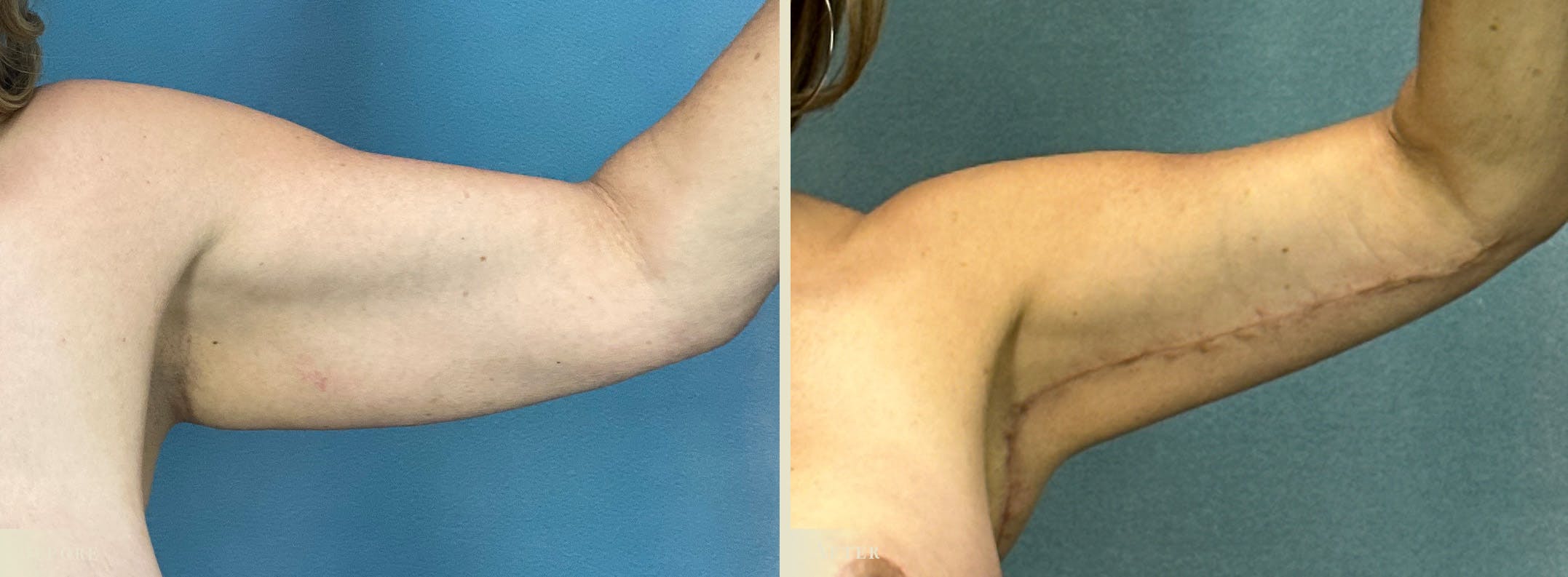 Explant with Lift Before & After Gallery - Patient 293873 - Image 2