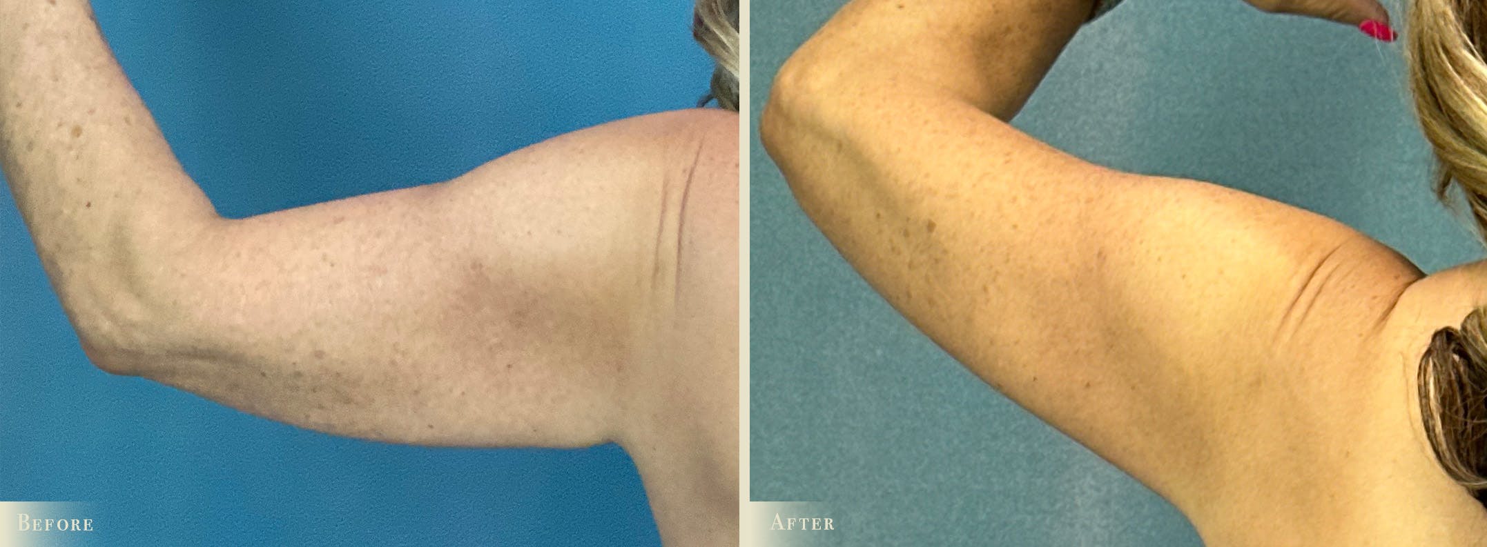 Explant with Lift Before & After Gallery - Patient 293873 - Image 5