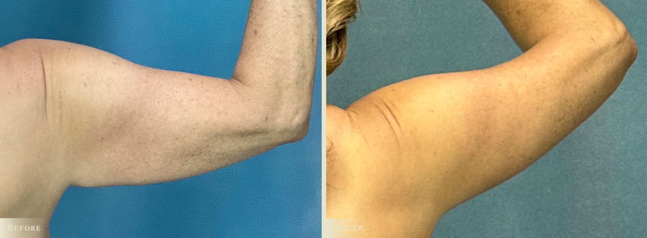 Explant with Lift Before & After Gallery - Patient 293873 - Image 3
