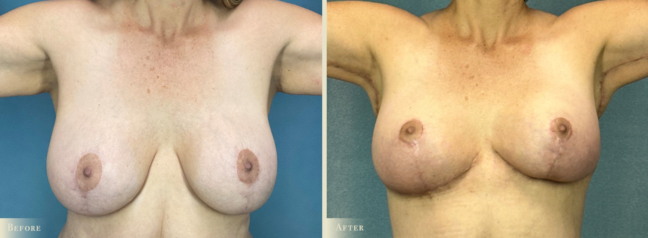 Explant with Lift Before & After Gallery - Patient 293873 - Image 1