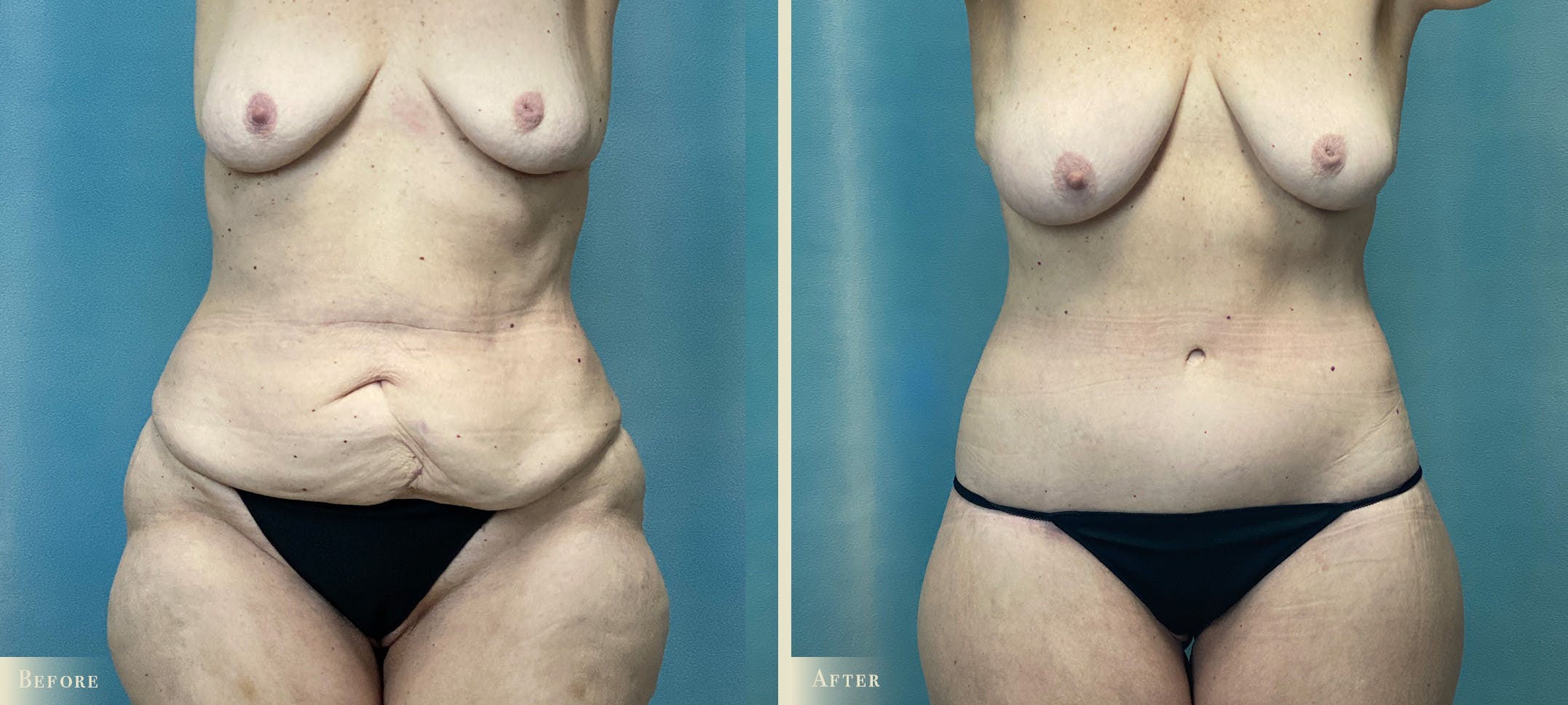 Brazilian Butt Lift Before & After Gallery - Patient 319991 - Image 2