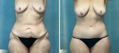 Body Lift Before & After Gallery - Patient 372421 - Image 1