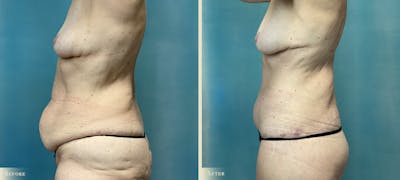 Brazilian Butt Lift Before & After Gallery - Patient 319991 - Image 3