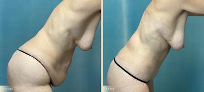 Brazilian Butt Lift Before & After Gallery - Patient 319991 - Image 4