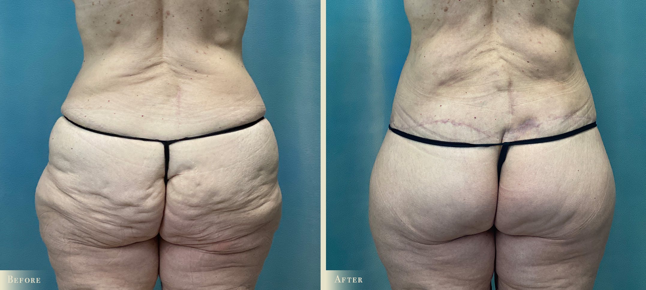 Brazilian Butt Lift Before & After Gallery - Patient 319991 - Image 1