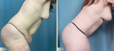 Brazilian Butt Lift Before & After Gallery - Patient 793352 - Image 4