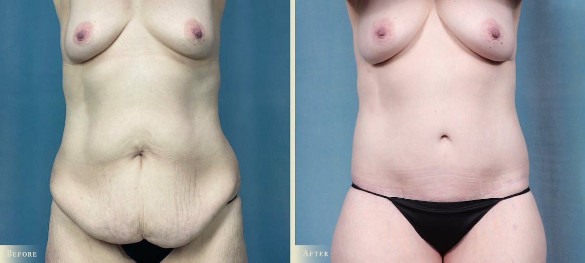 Brazilian Butt Lift Before & After Gallery - Patient 793352 - Image 2