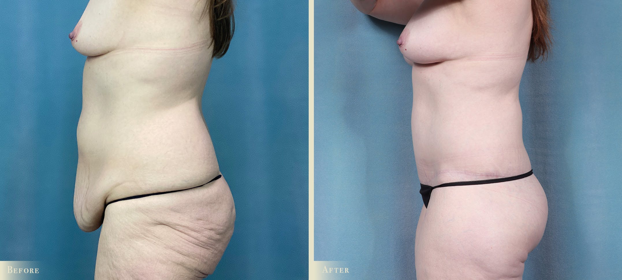 Brazilian Butt Lift Before & After Gallery - Patient 793352 - Image 3