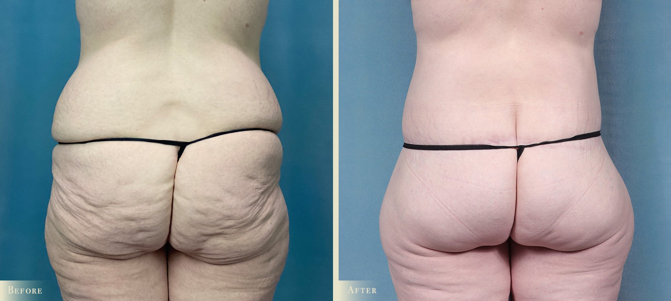 Brazilian Butt Lift Before & After Gallery - Patient 793352 - Image 1