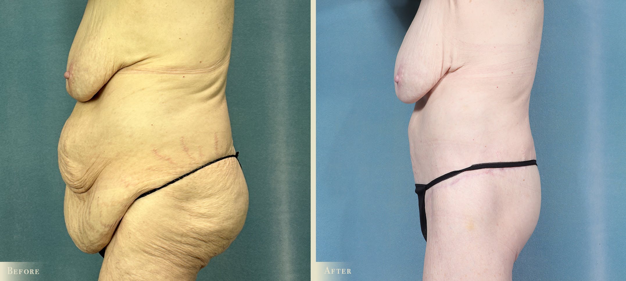 Brazilian Butt Lift Before & After Gallery - Patient 369932 - Image 3