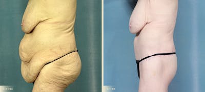 Brazilian Butt Lift Before & After Gallery - Patient 369932 - Image 3