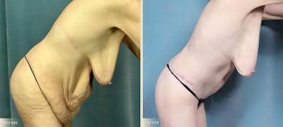 Brazilian Butt Lift Before & After Gallery - Patient 369932 - Image 4