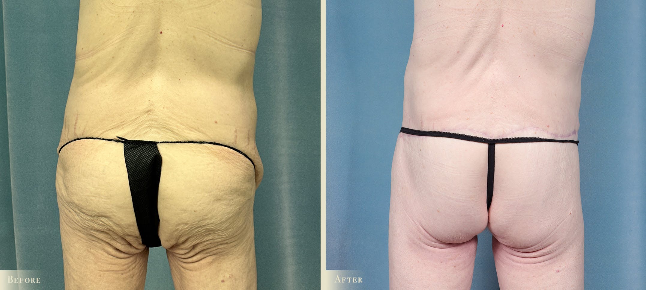 Brazilian Butt Lift Before & After Gallery - Patient 369932 - Image 1