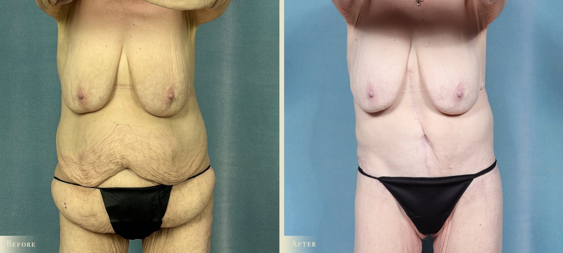 Brazilian Butt Lift Before & After Gallery - Patient 369932 - Image 2