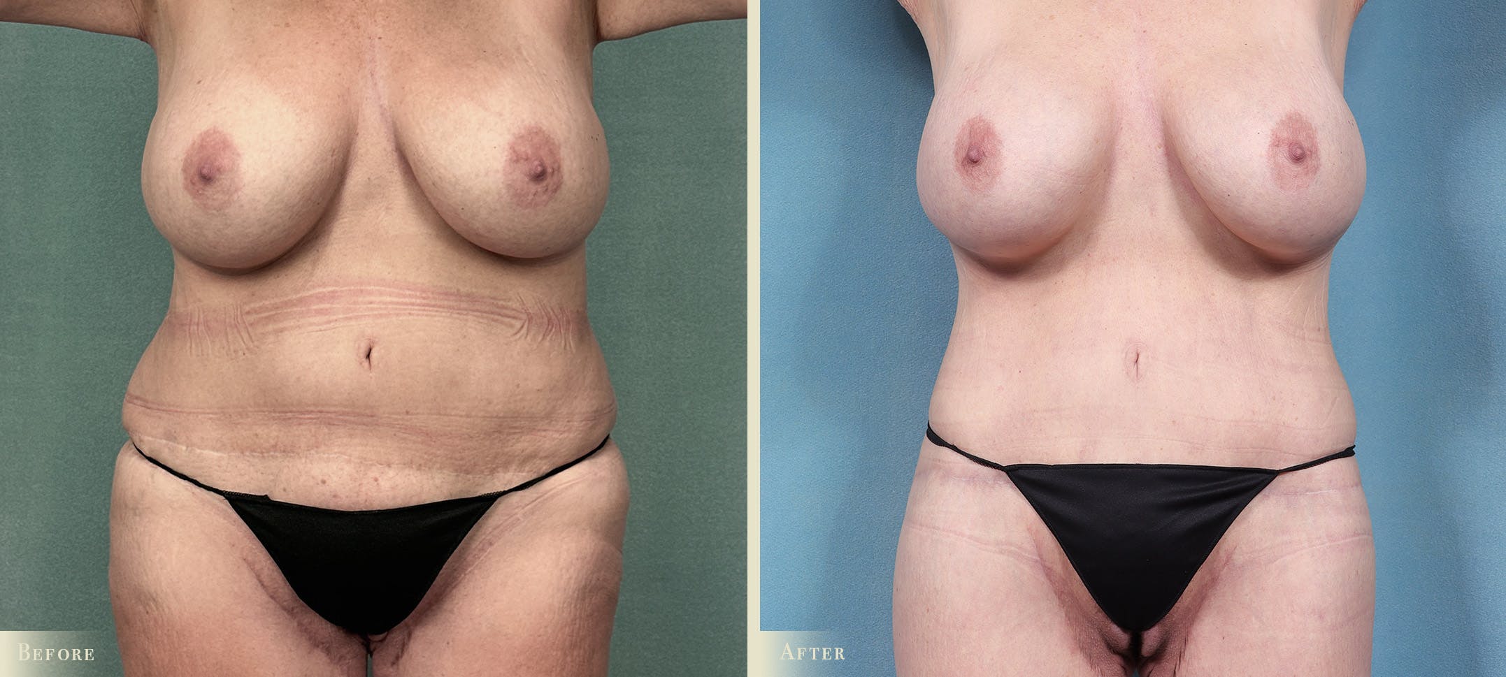 Brazilian Butt Lift Before & After Gallery - Patient 421580 - Image 2