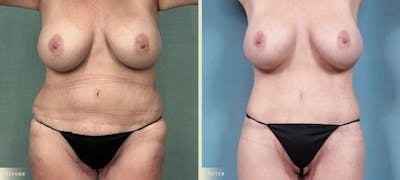 Body Lift Before & After Gallery - Patient 194603 - Image 1