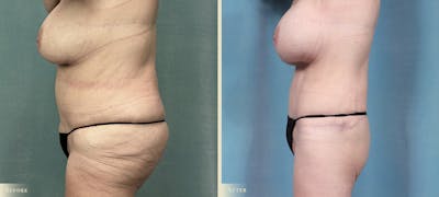 Brazilian Butt Lift Before & After Gallery - Patient 421580 - Image 3