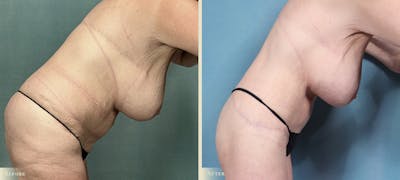 Brazilian Butt Lift Before & After Gallery - Patient 421580 - Image 4