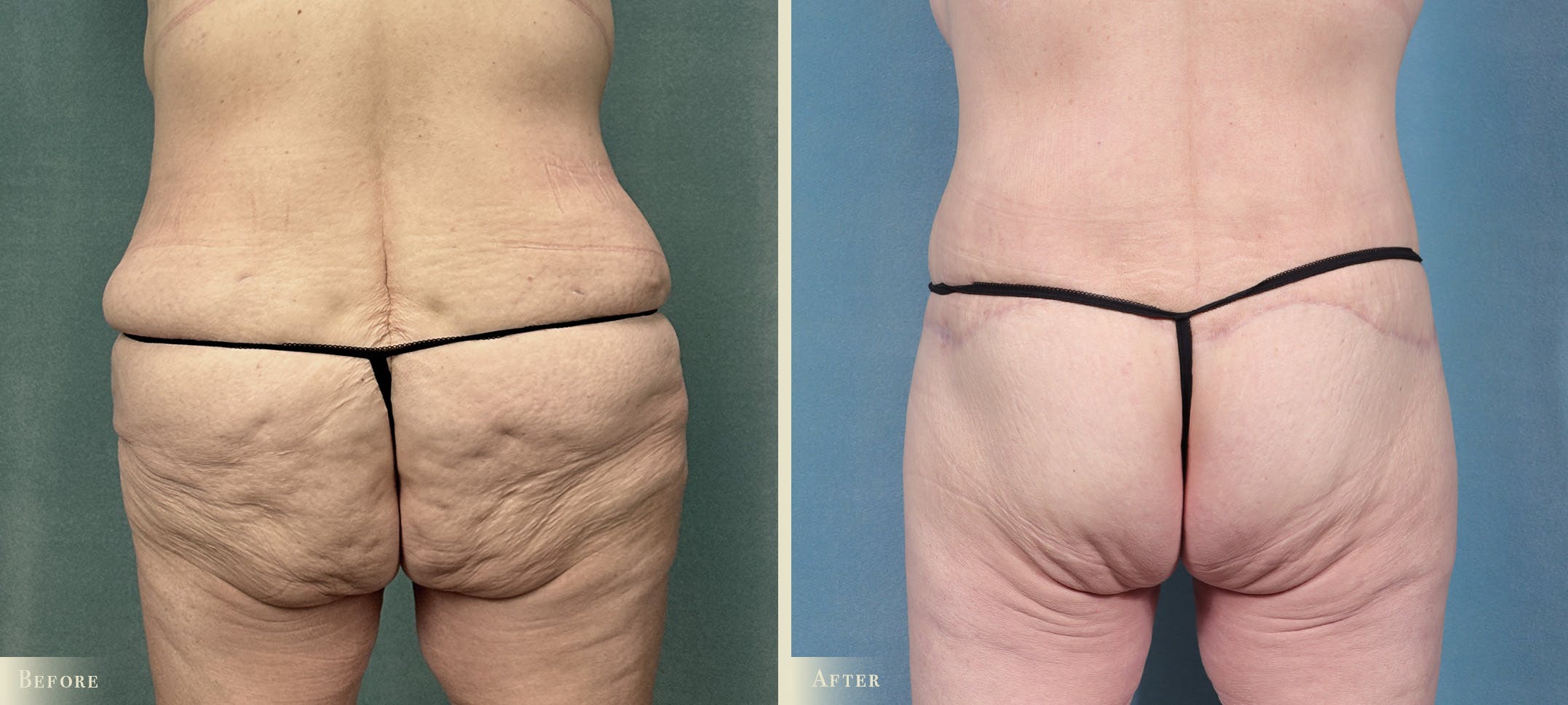 Brazilian Butt Lift Before & After Gallery - Patient 421580 - Image 1