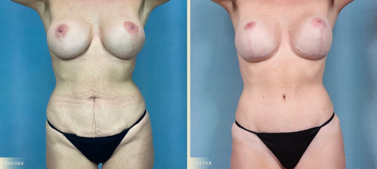 Mommy Makeover Before & After Gallery - Patient 316819 - Image 1