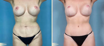 Tummy Tuck Before & After Gallery - Patient 361905 - Image 1