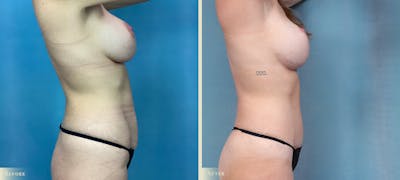 Mommy Makeover Before & After Gallery - Patient 316819 - Image 2